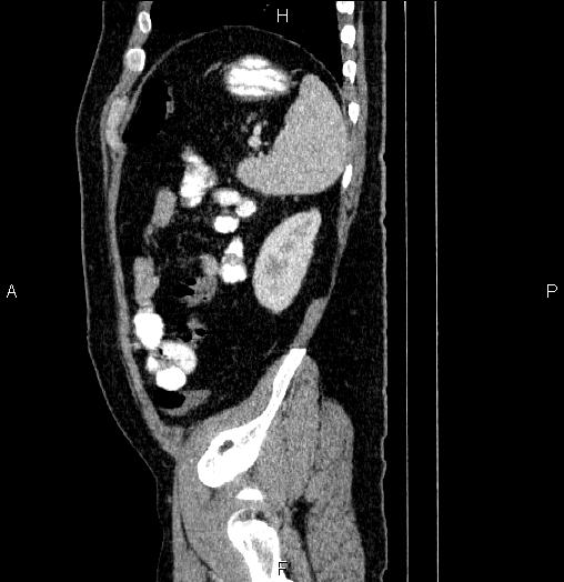 Acute pancreatitis (Radiopaedia 85390-101010 Sagittal C+ portal venous phase 86).jpg