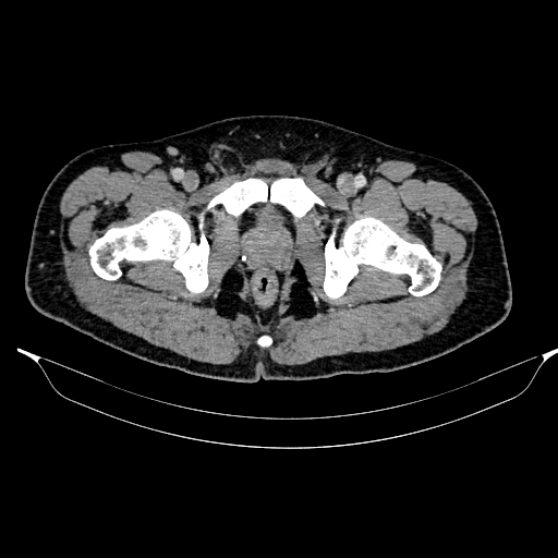 Acute pancreatitis (Radiopaedia 87428-103757 Axial C+ portal venous phase 95).jpg