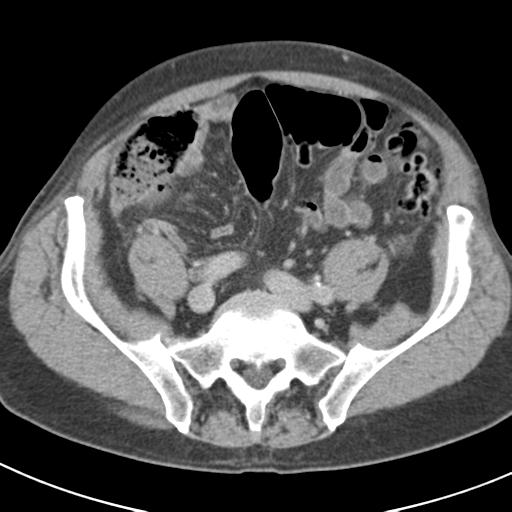 Acute pancreatitis and walled-off necrosis (Radiopaedia 29888-30403 Axial C+ delayed 62).jpg