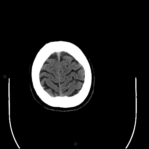Acute posterior cerebral artery territory infarct (Radiopaedia 79329-92393 Axial non-contrast 101).jpg