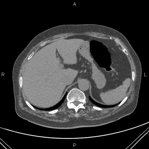 Acute renal artery occlusion (Radiopaedia 86586-102682 Axial non-contrast 13).jpg