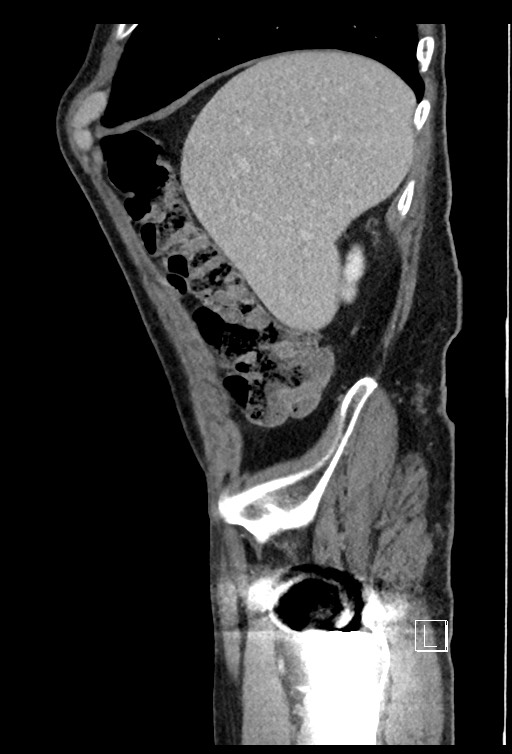 Acute renal infarction - rim capsular enhancement (Radiopaedia 59833-67270 Sagittal C+ portal venous phase 73).jpg
