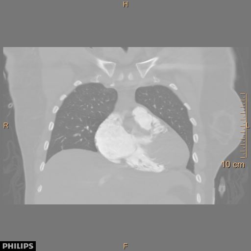 File:Acute reversible pulmonary hypertension and right heart failure from cocaine toxicity (Radiopaedia 49394-54517 Coronal C+ CTPA 11).jpg