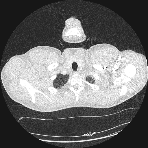 Acute segmental pulmonary emboli and pulmonary infarction (Radiopaedia 62264-70444 Axial lung window 2).jpg