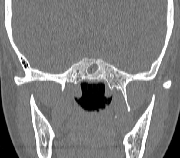 Acute sinusitis (Radiopaedia 40564-43158 Coronal bone window 41).jpg