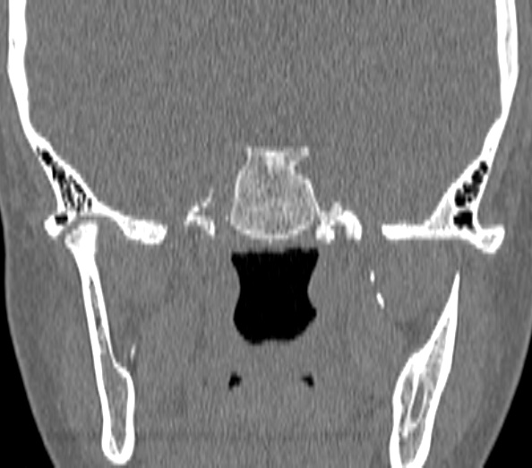 Acute sinusitis (Radiopaedia 40564-43158 Coronal bone window 45).jpg