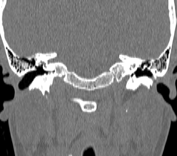 Acute sinusitis (Radiopaedia 40564-43158 Coronal bone window 58).jpg