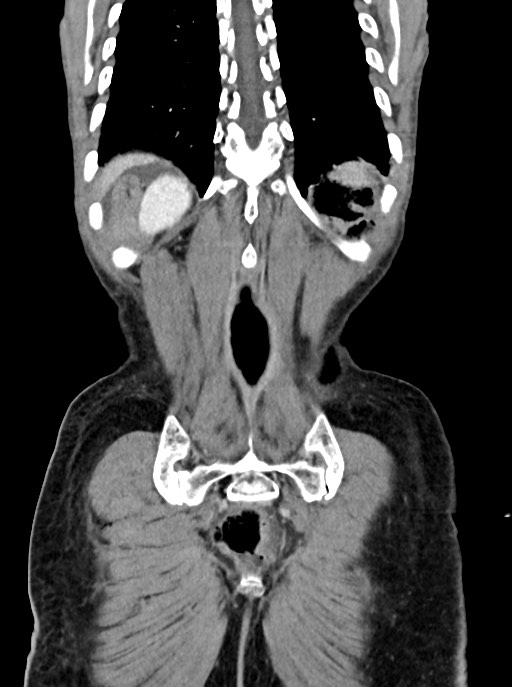 Acute small bowel (ileal) volvulus (Radiopaedia 71740-82139 Coronal C+ portal venous phase 98).jpg