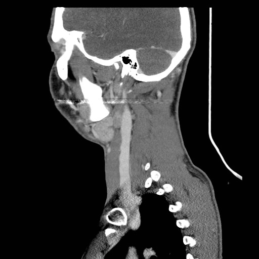 File:Acute submandibular sialadenitis secondary to ductal stone (Radiopaedia 27999-28267 Sagittal C+ delayed 8).jpg