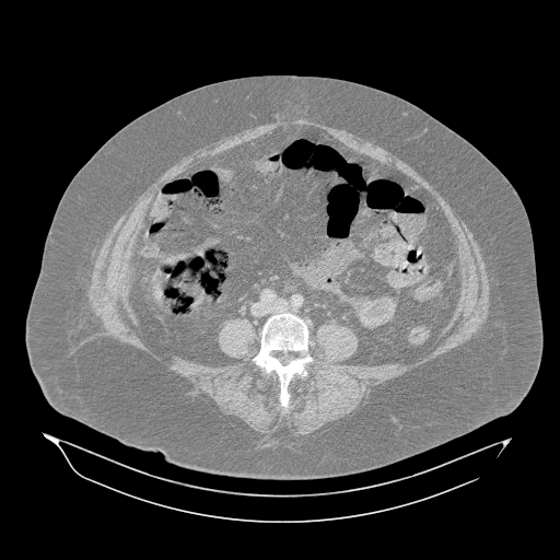 Acute superior mesenteric artery occlusion (Radiopaedia 51288-56960 Axial lung window 41).jpg