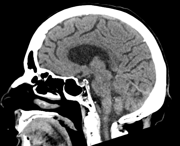 Acute traumatic subdural hematoma (Radiopaedia 82921-97257 Sagittal non-contrast 36).jpg