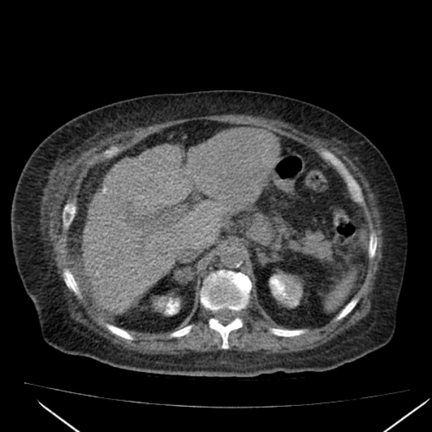 Acute tubular necrosis (Radiopaedia 28077-28334 F 22).jpg