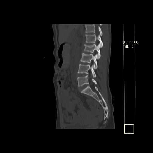 File:Acute vertebral compression fracture (Radiopaedia 63832-72559 Sagittal bone window 16).jpg