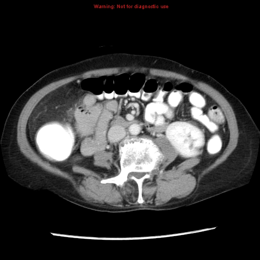 File:Adenocarcinoma of the colon (Radiopaedia 8191-9039 Axial liver window 39).jpg