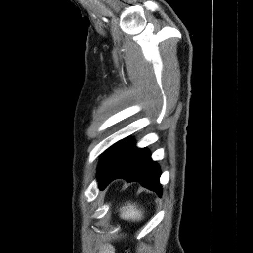 Adenocarcinoma of the lung (Radiopaedia 59871-67325 Sagittal C+ arterial phase 97).jpg