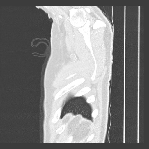 Adenocarcinoma of the lung (Radiopaedia 59871-67325 Sagittal lung window 98).jpg