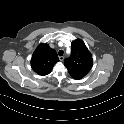 Adenocarcioma of rectum- T1 lesion (Radiopaedia 36921-38547 Axial C+ arterial phase 15).png