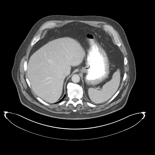 File:Adenocarcioma of rectum- T1 lesion (Radiopaedia 36921-38547 Axial C+ portal venous phase 18).png