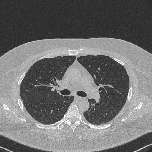 File:Adenoid cystic carcinoma of the trachea (Radiopaedia 49042-54137 Axial lung window 139).jpg