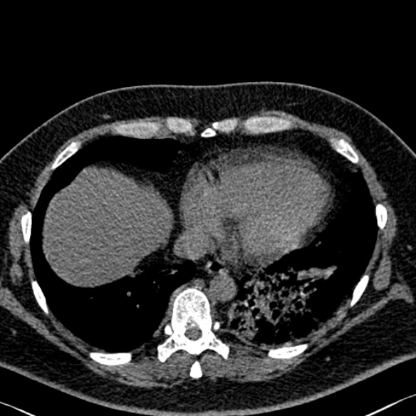 Adenoid cystic carcinoma of the trachea (Radiopaedia 49042-54137 Axial non-contrast 261).jpg