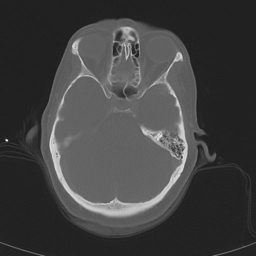 Adenoid cystic tumor of palate (Radiopaedia 46980-51518 Axial bone window 11).png