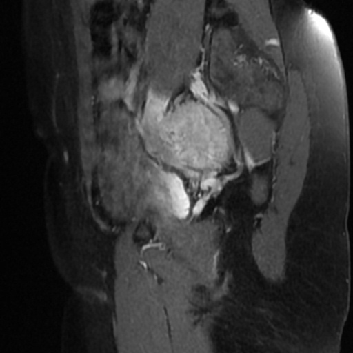 File:Adenoma malignum of cervix (Radiopaedia 66441-75705 Sagittal T1 C+ fat sat 2).jpg
