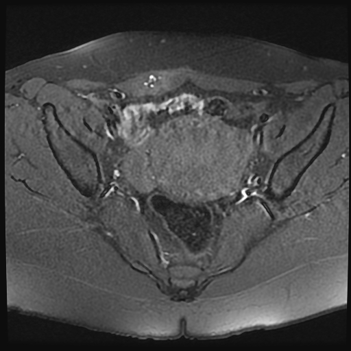 File:Adenomyosis-scar endometriosis (Radiopaedia 65863-75022 Axial T1 fat sat 13).jpg