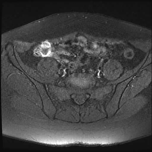 File:Adenomyosis-scar endometriosis (Radiopaedia 65863-75022 Axial T1 fat sat 3).jpg