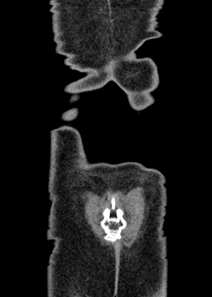 Adhesional small bowel obstruction (Radiopaedia 48397-53305 Coronal C+ portal venous phase 344).jpg