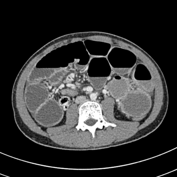 File:Adhesional small bowel obstruction (Radiopaedia 52107-57980 Axial C+ portal venous phase 62).jpg