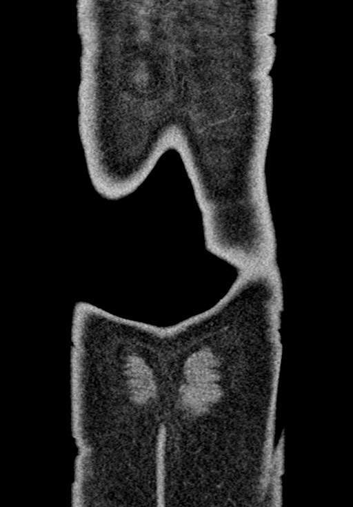 Adhesional small bowel obstruction (Radiopaedia 58900-66131 Coronal C+ portal venous phase 235).jpg