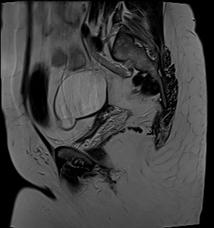 File:Adnexal multilocular cyst (O-RADS US 3- O-RADS MRI 3) (Radiopaedia 87426-103754 Sagittal T2 18).jpg