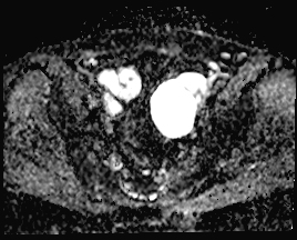 File:Adnexal multilocular cyst (O-RADS US 3. O-RADS MRI 3) (Radiopaedia 87426-103754 Axial 159).jpeg