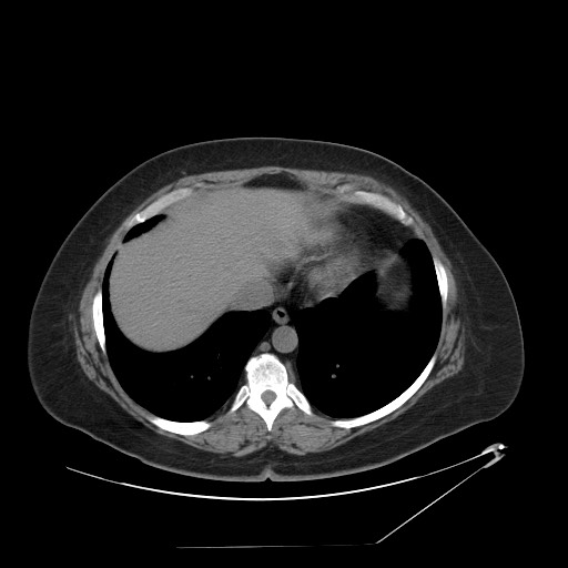 Adrenal angiosarcoma (Radiopaedia 81081-94671 Axial non-contrast 8).jpg