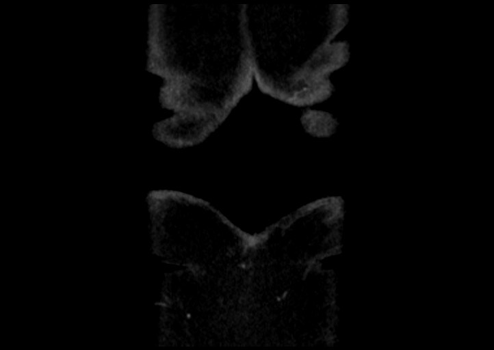 Adrenal cortical carcinoma (Radiopaedia 64017-72769 Coronal C+ portal venous phase 59).jpg