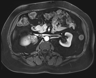 File:Adrenal cortical carcinoma (Radiopaedia 64017-72770 I 42).jpg