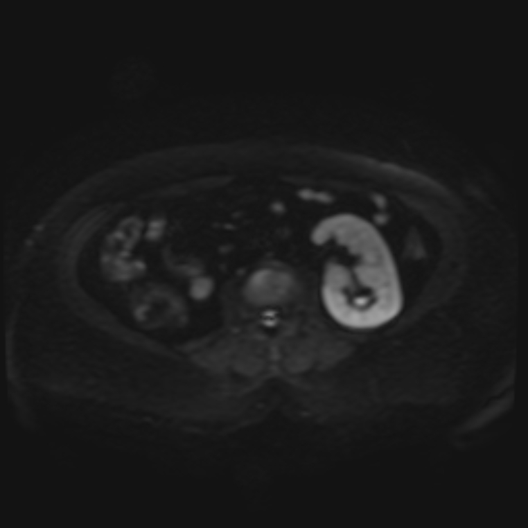 Adrenal cortical carcinoma (Radiopaedia 70906-81116 Axial DWI 21).jpg