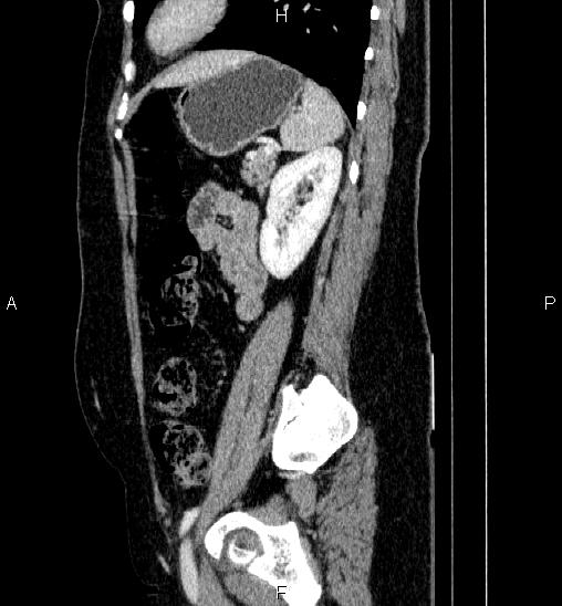 Adrenal cortical carcinoma (Radiopaedia 84882-100379 Sagittal C+ portal venous phase 64).jpg