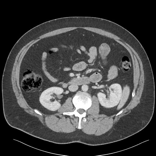 File:Adrenal cyst (Radiopaedia 45625-49777 Axial C+ portal venous phase 47).png