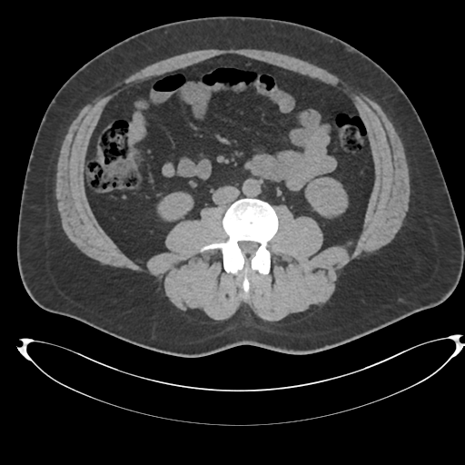 Adrenal cyst (Radiopaedia 45625-49778 Axial non-contrast 69).png