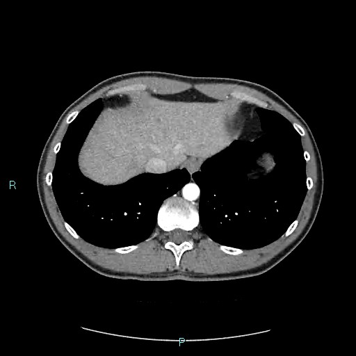 File:Adrenal cystic lymphangioma (Radiopaedia 83161-97534 Axial C+ arterial phase 14).jpg