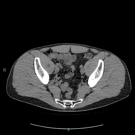 Adrenal cystic lymphangioma (Radiopaedia 83161-97534 Axial non-contrast 83).jpg