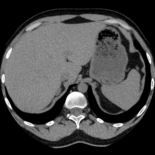 Adrenal gland trauma (Radiopaedia 81351-95079 Axial non-contrast 22).jpg