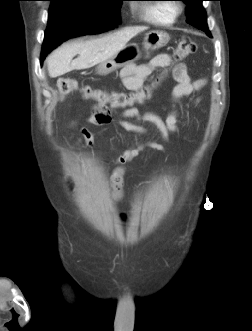 Adrenal hematoma (Radiopaedia 44334-47968 Coronal C+ portal venous phase 13).png