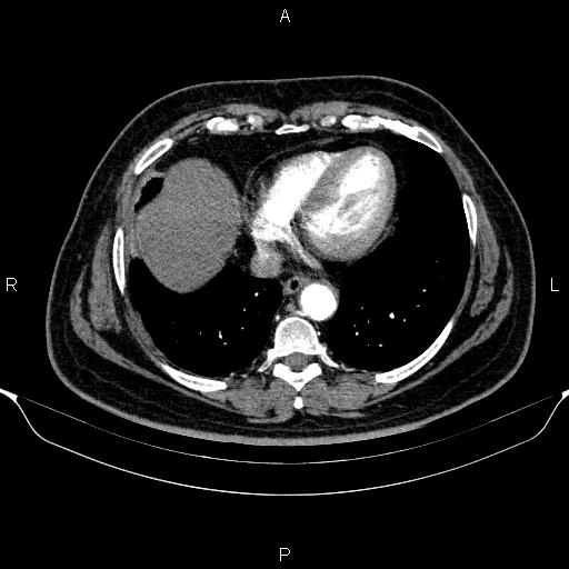 Adrenal hemorrhage (Radiopaedia 62622-70916 Axial C+ arterial phase 13).jpg