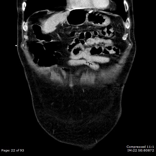Adrenal metastasis (Radiopaedia 78425-91079 Sagittal C+ portal venous phase 9).jpg