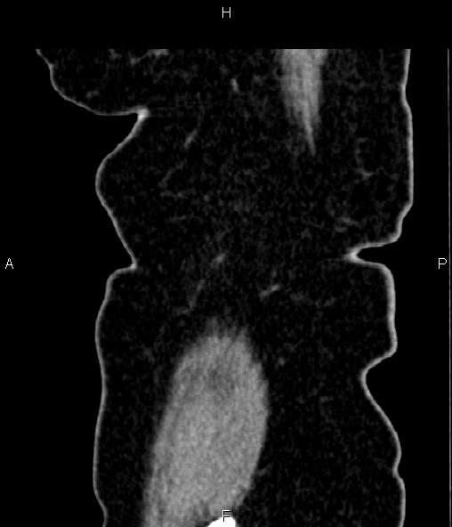 Adrenal myelolipoma (Radiopaedia 82742-96986 Sagittal renal cortical phase 103).jpg
