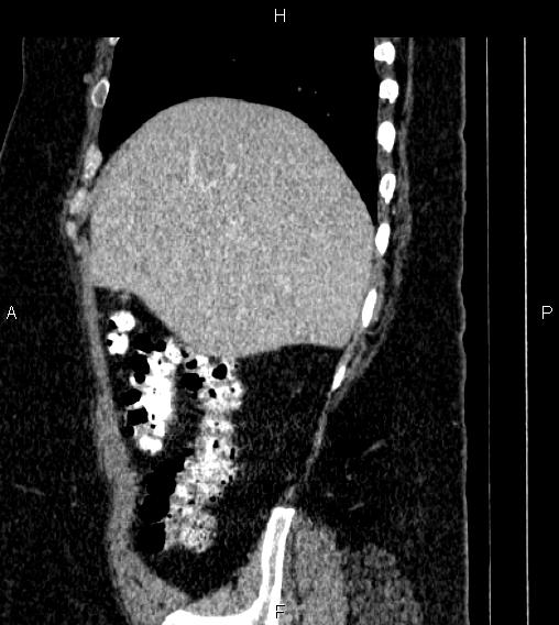 Adrenal myelolipoma (Radiopaedia 84319-99617 Sagittal renal cortical phase 17).jpg