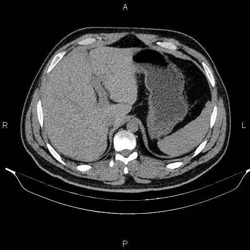 Adrenal myelolipoma (Radiopaedia 84321-99619 Axial non-contrast 24).jpg