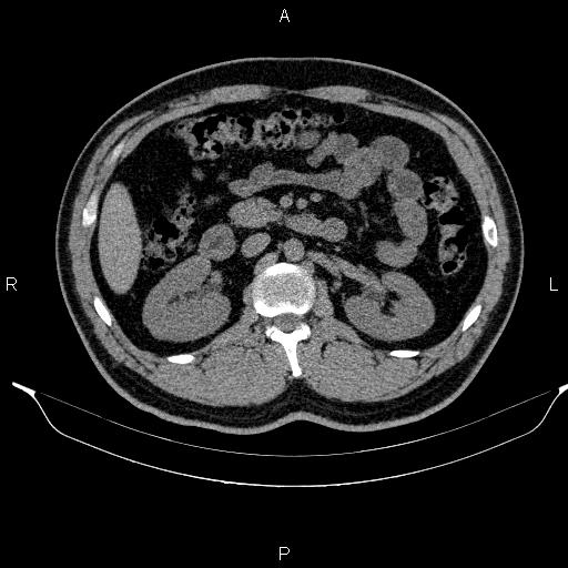 File:Adrenal myelolipoma (Radiopaedia 84321-99619 Axial non-contrast 47).jpg
